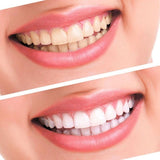 3D Whitestrips - Professional Level Treatment