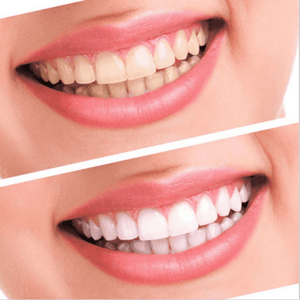 Top Quality Teeth Whitening Kit